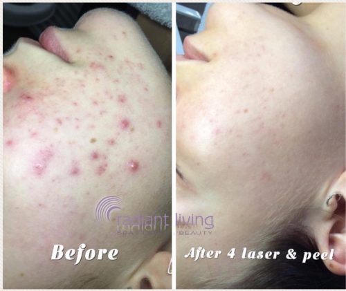 best treatment for acne