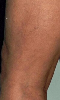 vein-removal-leg