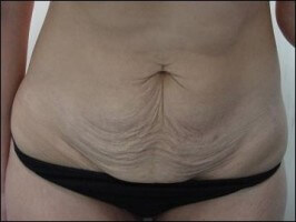 tripollar fat burning