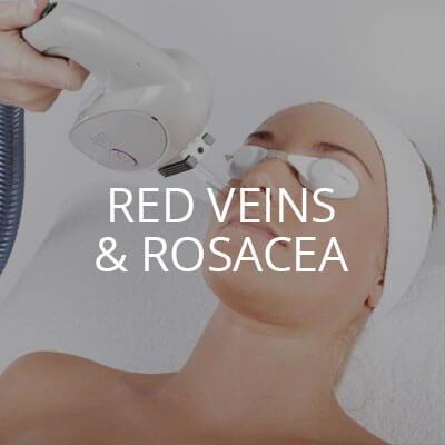 red veins rosacea