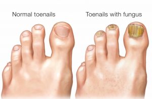 fungal nail treatment