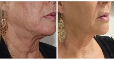 HIFU Neck Lift Treatment