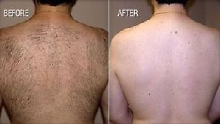 Laser Hair Removal for Men
