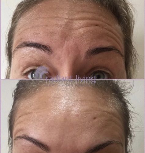 Botox Treatment