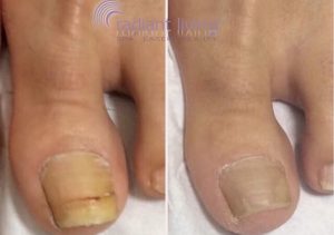 get rid of toenail fungus