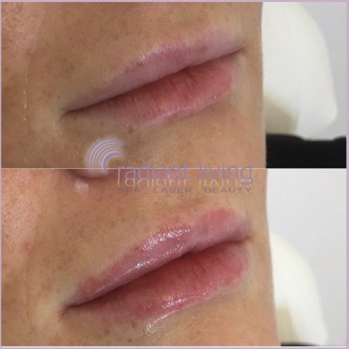 Lip Fillers Before and After