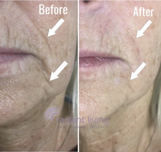 Nose to Mouth Fillers