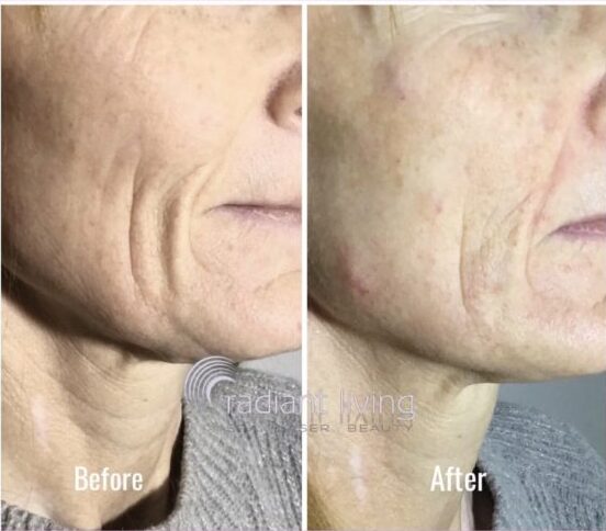 What is a skin booster