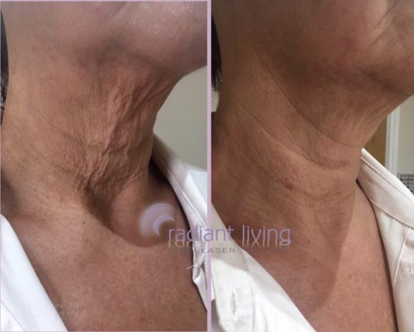 Can you tighten a saggy neck without surgery?