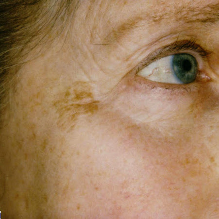 Can you get rid of age spots?