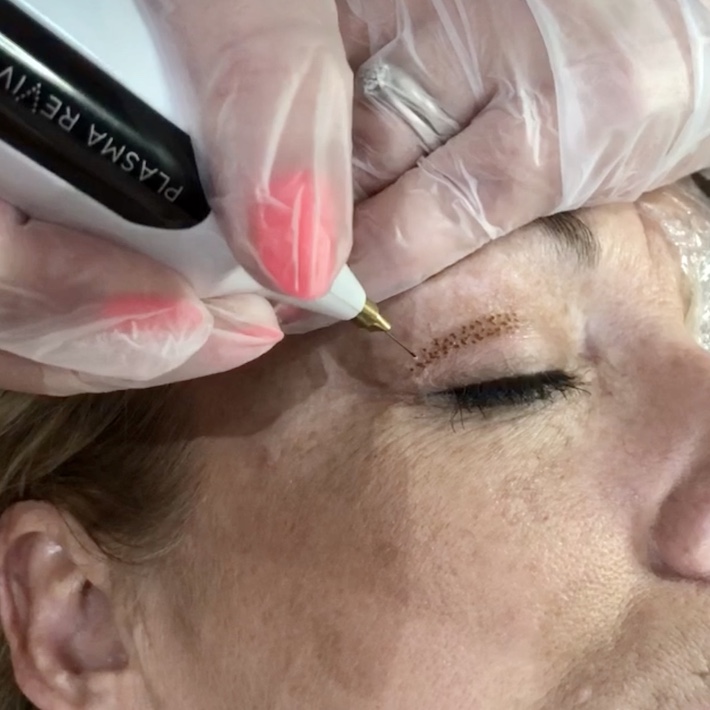 Can Plasma Pen leave scars?