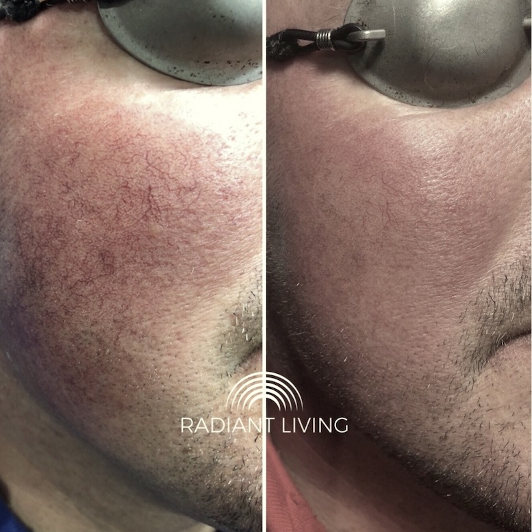 How does laser thread vein removal work?