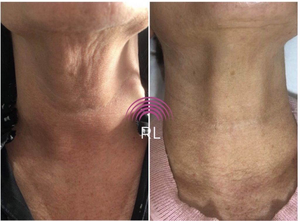 Saggy Neck Treatment