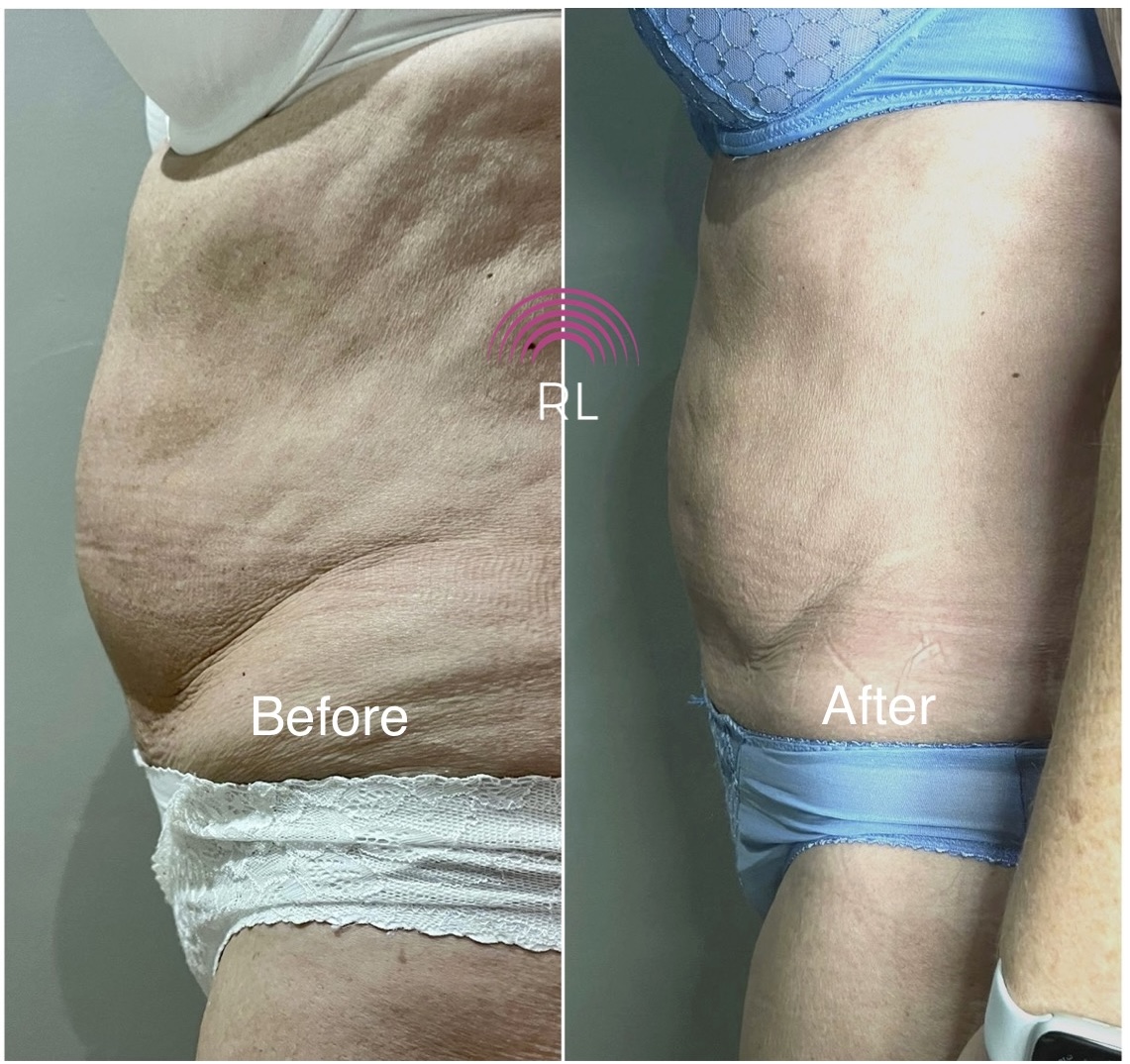 EvoSculpt body sculpting