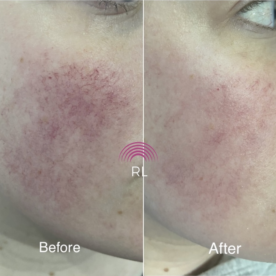 Thread veins on cheeks