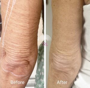 Skin Tightening Arms at Radiant Living