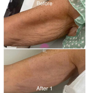 Bingo Wings Skin Tightening Wigan